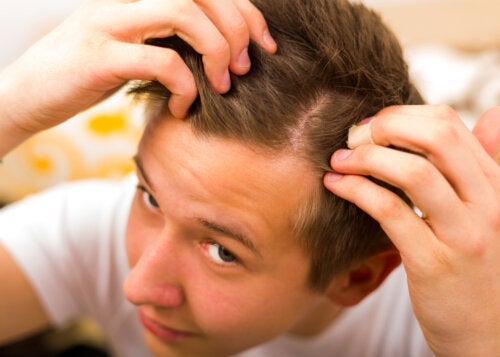 Hur man förhindrar juvenil alopeci