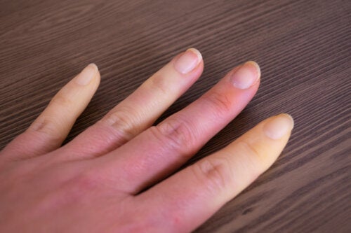 Vad är Raynauds sjukdom?