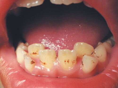 Fläckar på barns tänder på grund av järntillskott