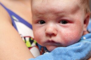 Petekier hos spädbarn: symtom, orsaker och behandling