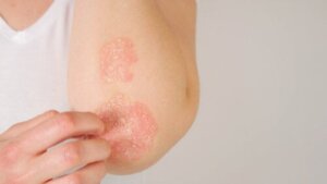 Vad du bör veta om psoriasis under graviditeten