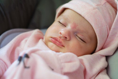 Änglakyssar och storkbett: födelsemärken på nyfödda