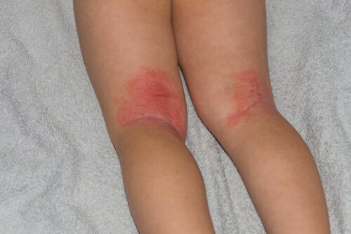Erytrodermi hos barn: symtom, orsaker och behandlingar