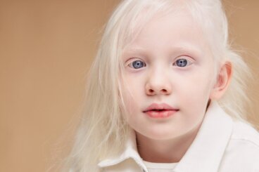 Hur tar man hand om huden hos barn med albinism? 4 strategier
