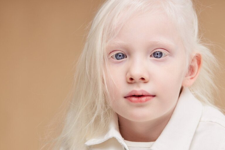 Hur tar man hand om huden hos barn med albinism? 4 strategier